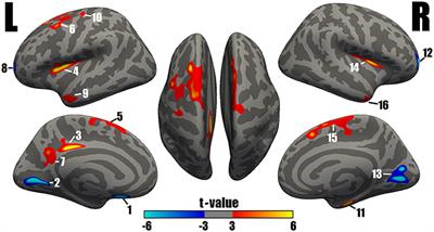 Altered Structural Covariance Among the Dorsolateral Prefrontal Cortex and Amygdala in Treatment-Naïve Patients With Major Depressive Disorder